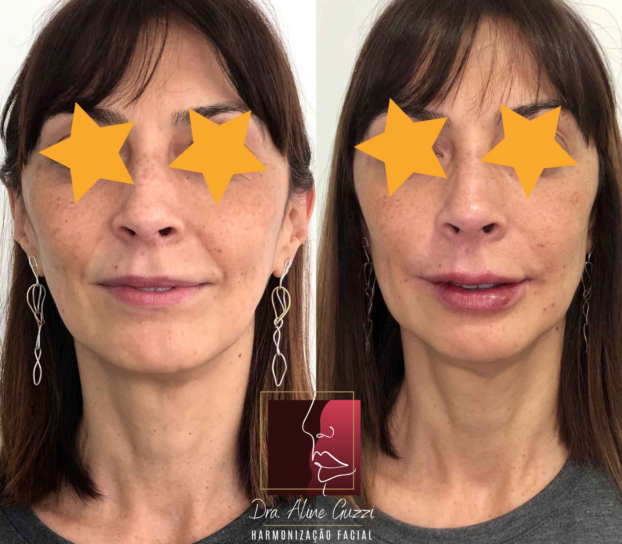 Harmonização Facial - Dra. Aline Guzzi: Caso Clínico de Bioestimulador