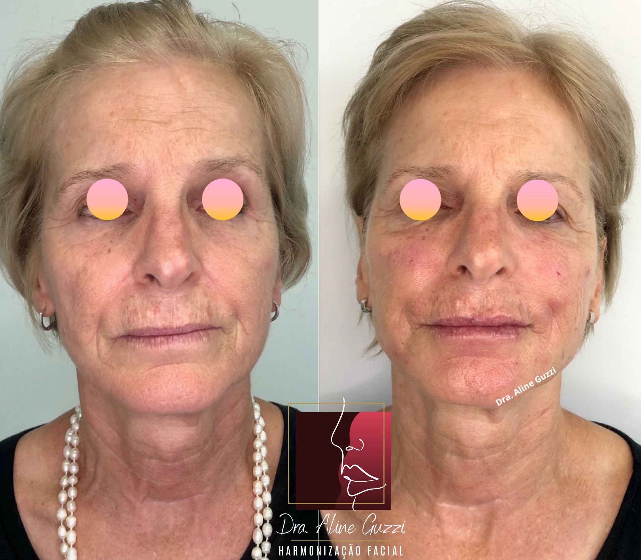 Harmonização Facial - Dra. Aline Guzzi: Caso Clínico de Bioestimulador