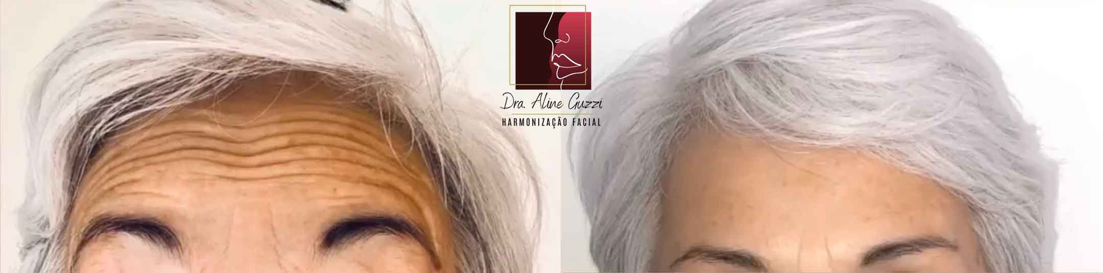 Harmonização Facial - Dra. Aline Guzzi: Caso Clínico de Botox