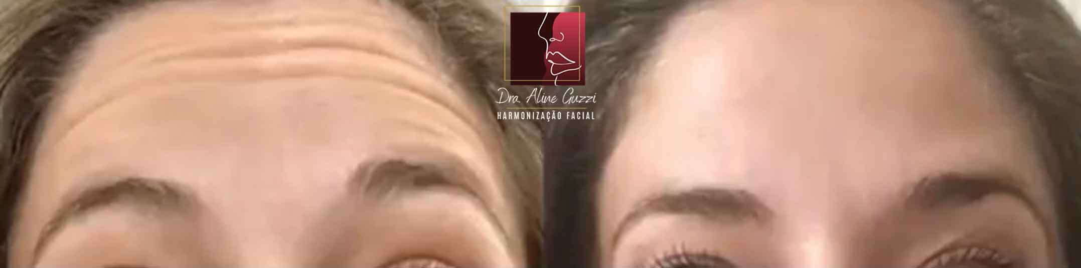 Harmonização Facial - Dra. Aline Guzzi: Caso Clínico de Botox