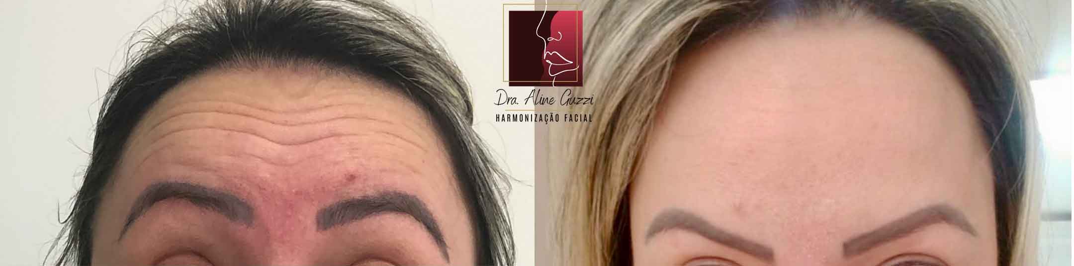 Harmonização Facial - Dra. Aline Guzzi: Caso Clínico de Botox