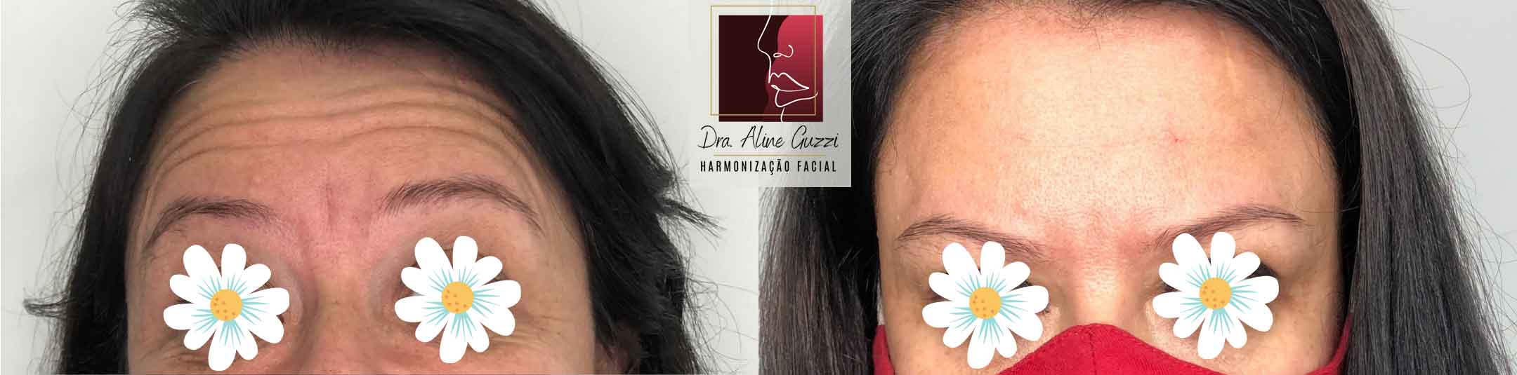 Harmonização Facial - Dra. Aline Guzzi: Caso Clínico de Botox
