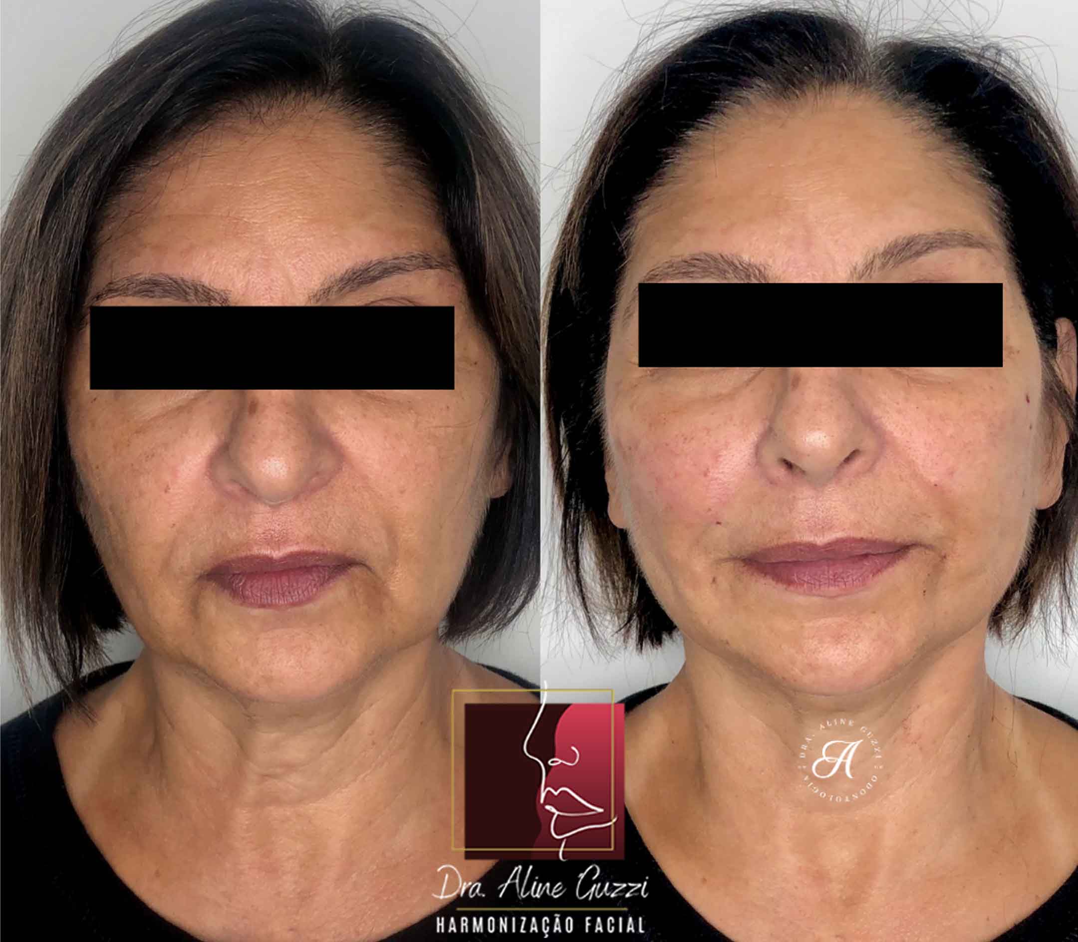 Harmonização Facial - Dra. Aline Guzzi: Caso Clínico de Fios Faciais