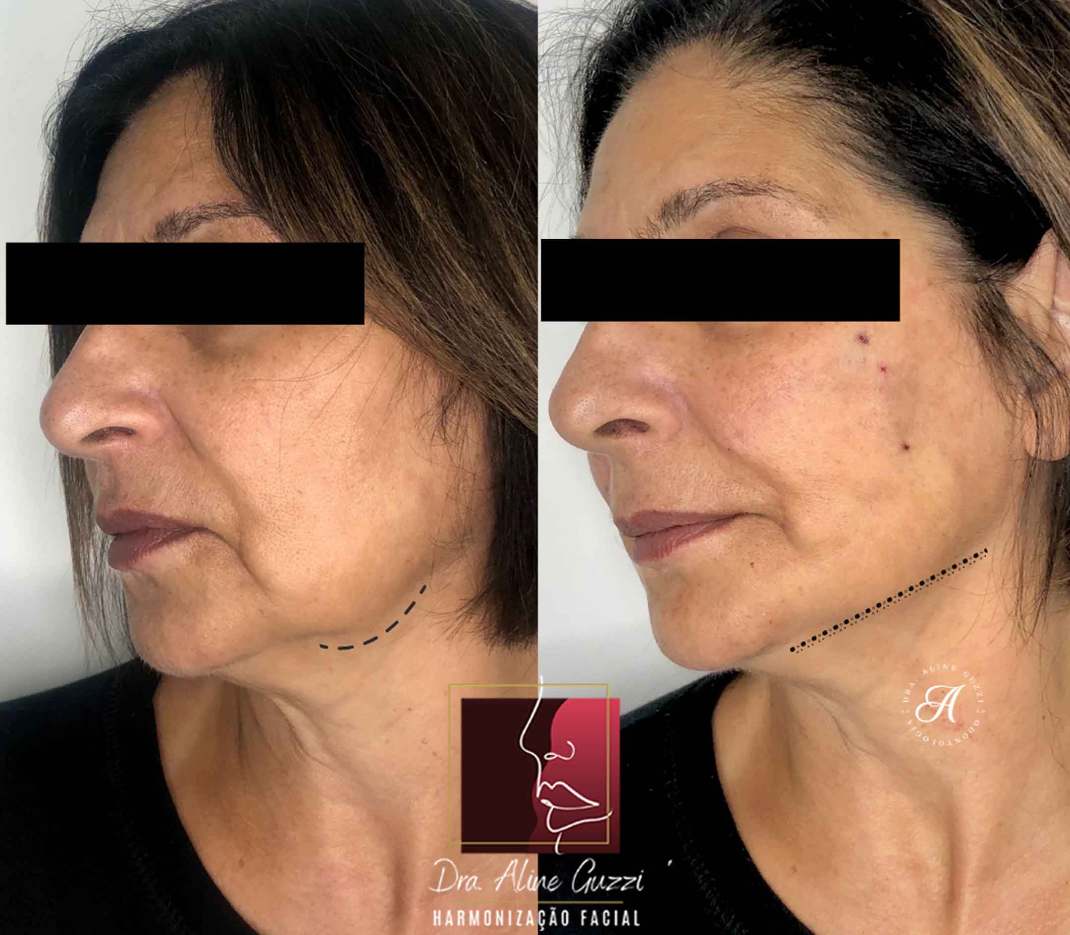 Harmonização Facial - Dra. Aline Guzzi: Caso Clínico de Fios Faciais