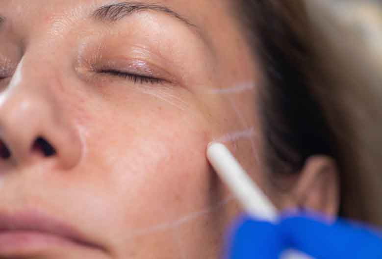 Harmonização Facial - Dra. Aline Guzzi: Fios Faciais