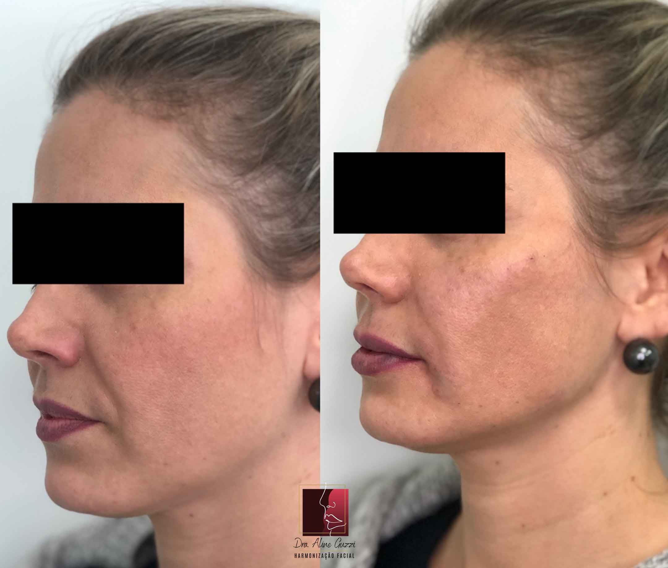 Harmonização Facial - Dra. Aline Guzzi: Caso Clínico de Preenchimento Facial