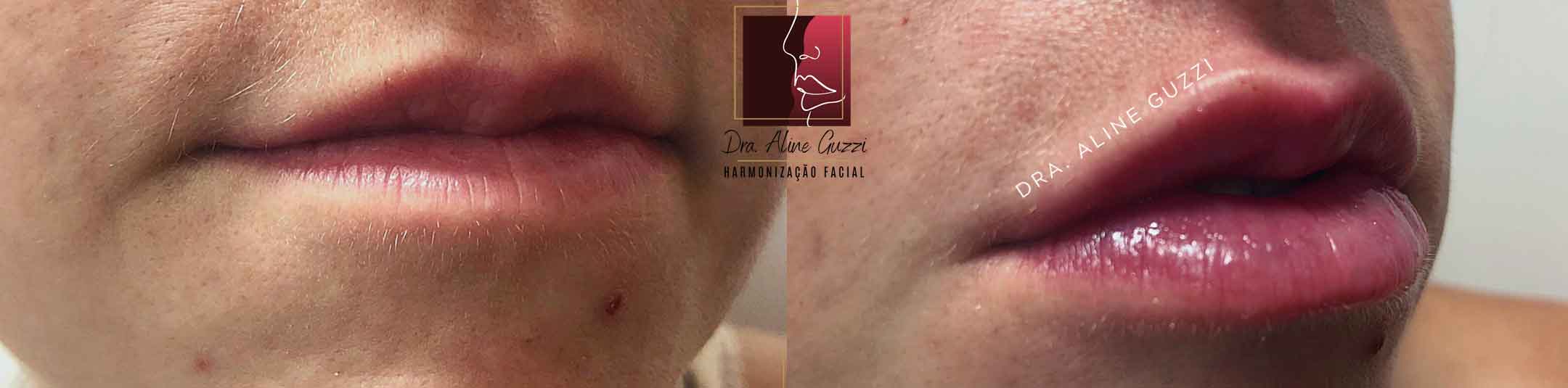 Harmonização Facial - Dra. Aline Guzzi: Caso Clínico de Preenchimento Facial