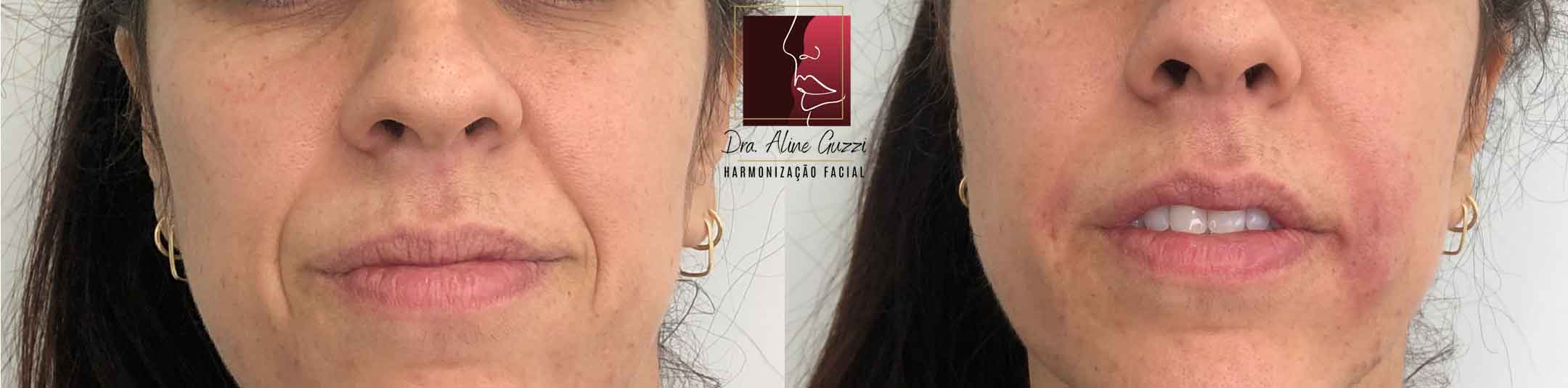 Harmonização Facial - Dra. Aline Guzzi: Caso Clínico de Preenchimento Facial