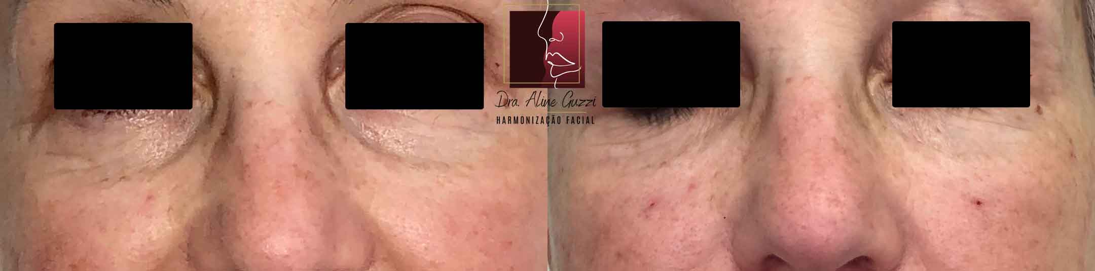 Harmonização Facial - Dra. Aline Guzzi: Caso Clínico de Preenchimento Facial