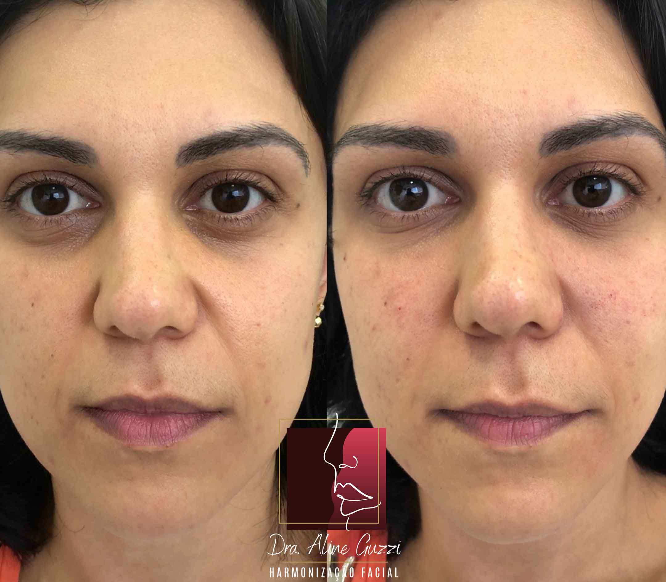 Harmonização Facial - Dra. Aline Guzzi: Caso Clínico de Preenchimento Facial