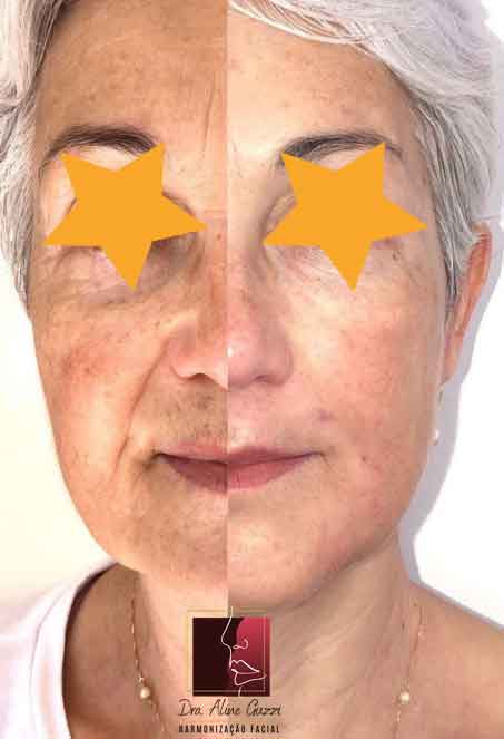 Harmonização Facial - Dra. Aline Guzzi: Caso Clínico de Rejuvenecimento